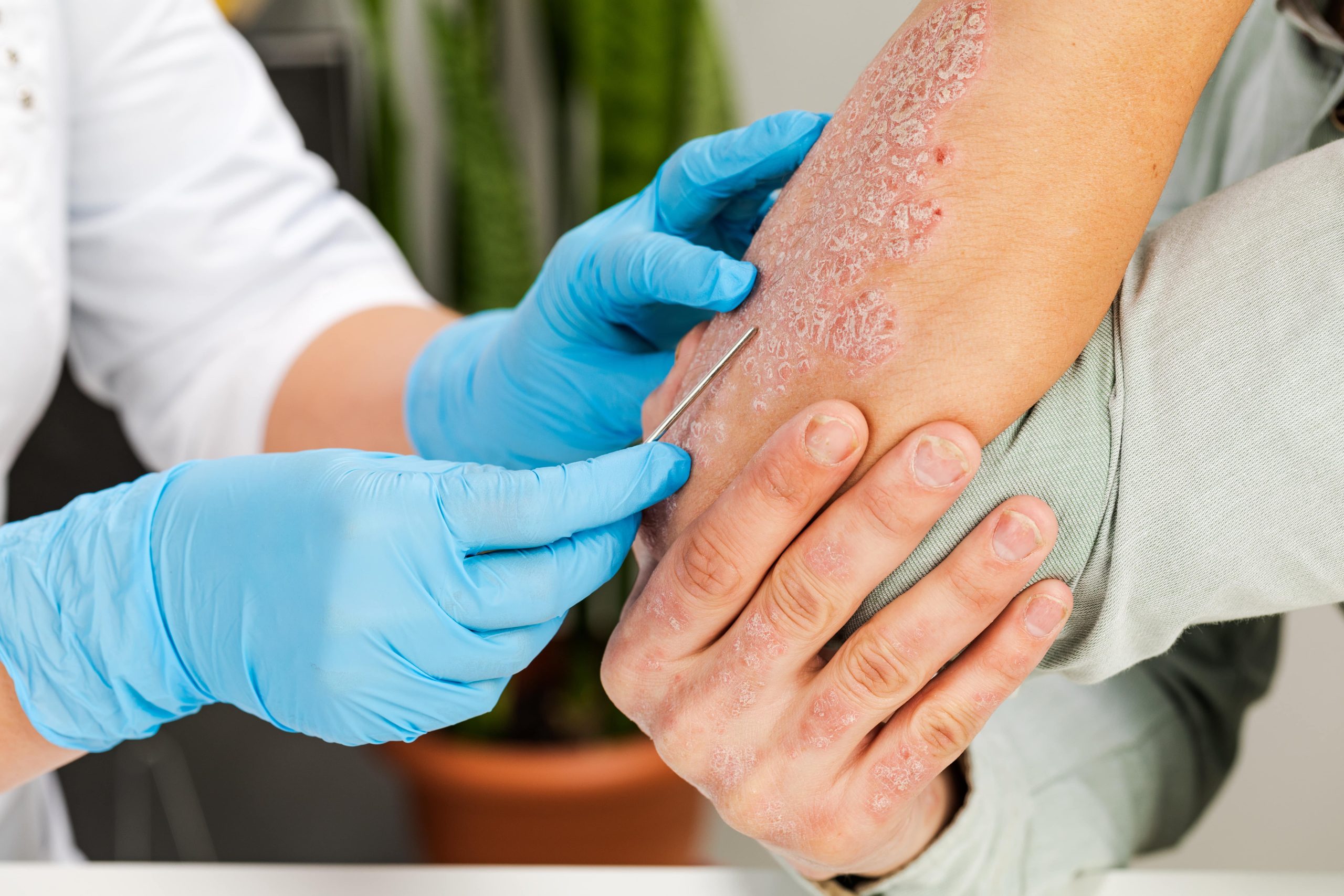 Eczema and Psoriasis|