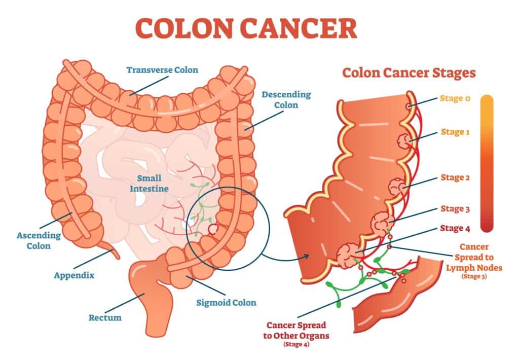 colon cancer in CT|colon cancer screening CT