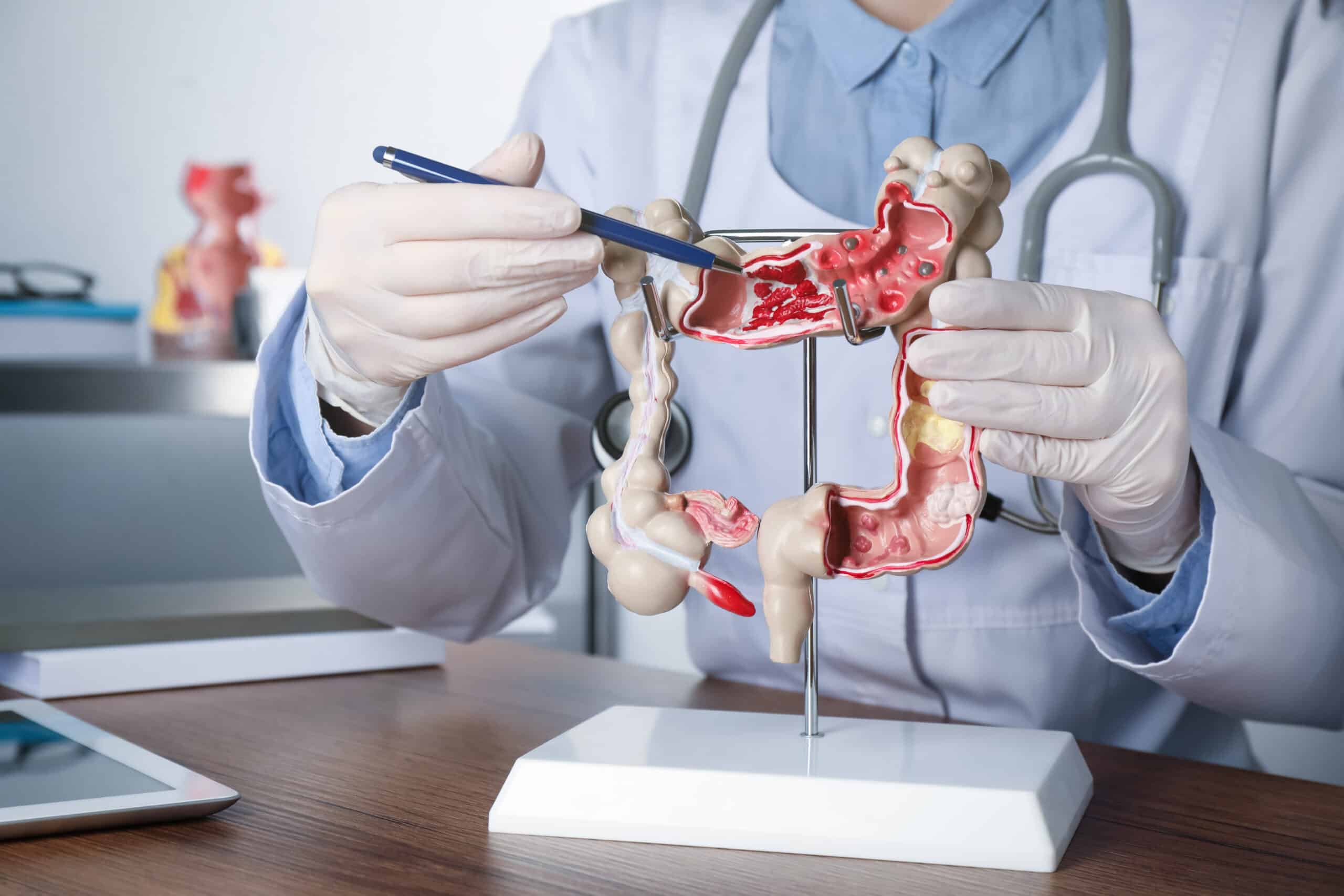 colon cancer symptoms