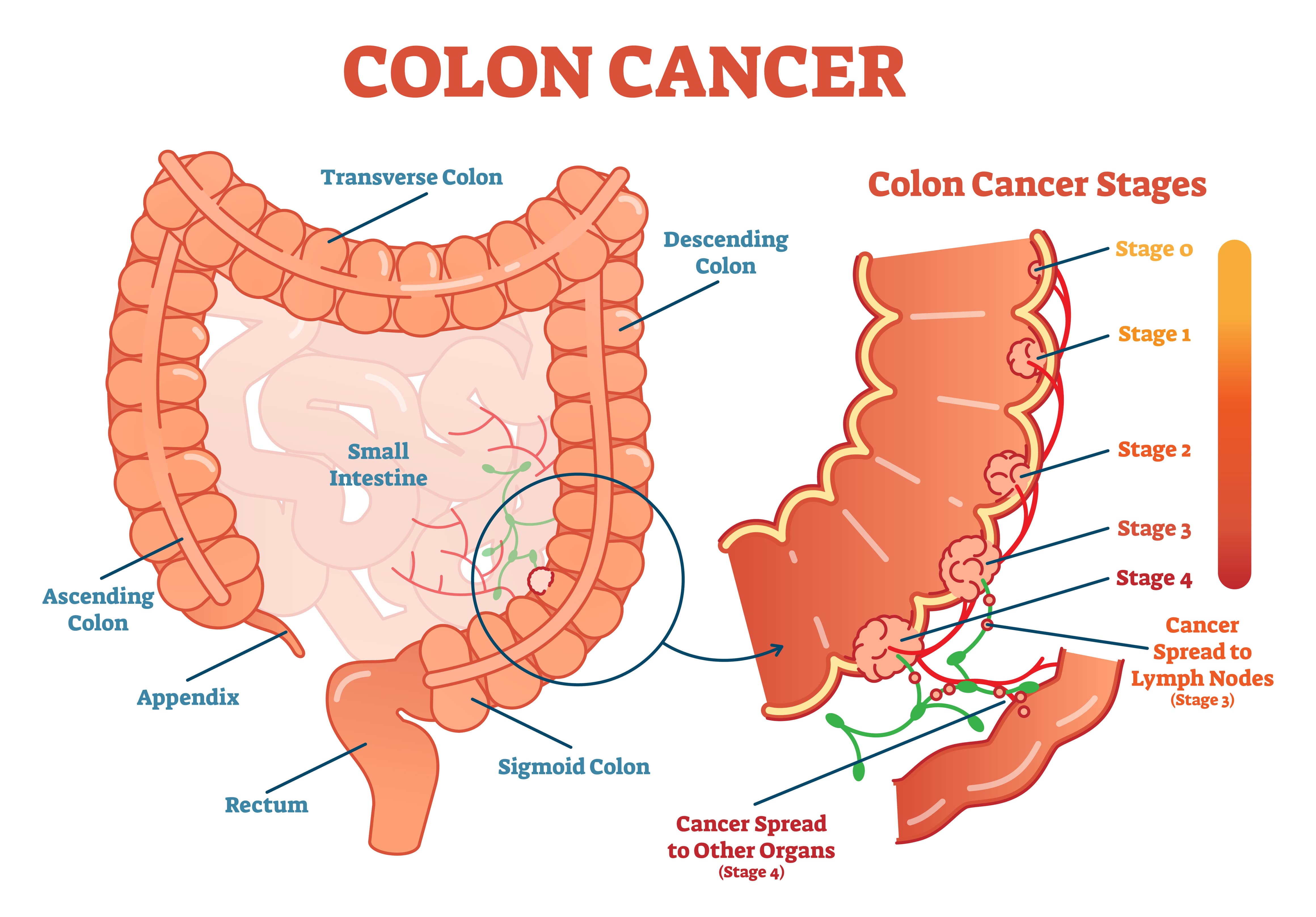 colon cancer in CT